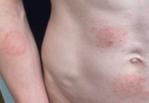 Une nouvelle ITS fongique inquiète : ce qu’il faut savoir sur le TMVII